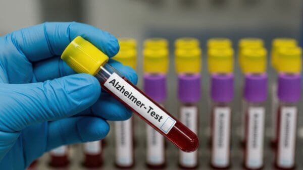 alzheimer disease