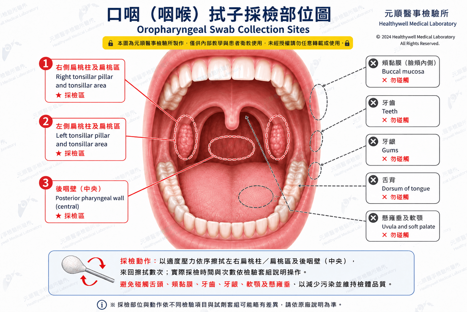 口腔淋病採檢圖 口腔淋病採檢圖
